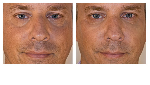 juvederm-03.jpg juvederm-03.jpg